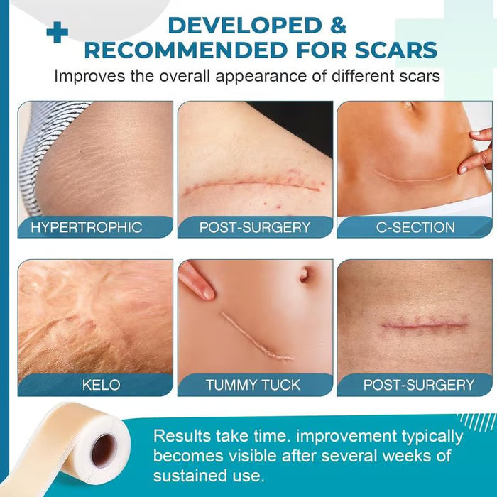 🎁BUY 1 GET 1 FREE 💥 Silicone gel scar patch