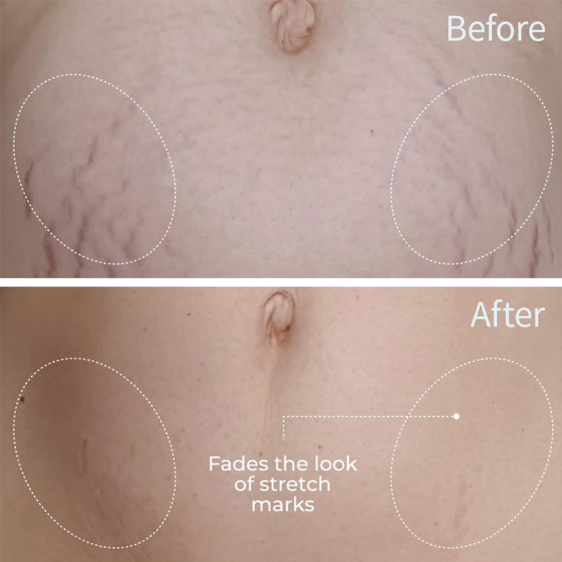 Newyuo™ Skin Care Oil for Stretch Marks, Scars, Vegan & Paraben Free