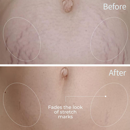 Newyuo™ Skin Care Oil for Stretch Marks, Scars, Vegan & Paraben Free