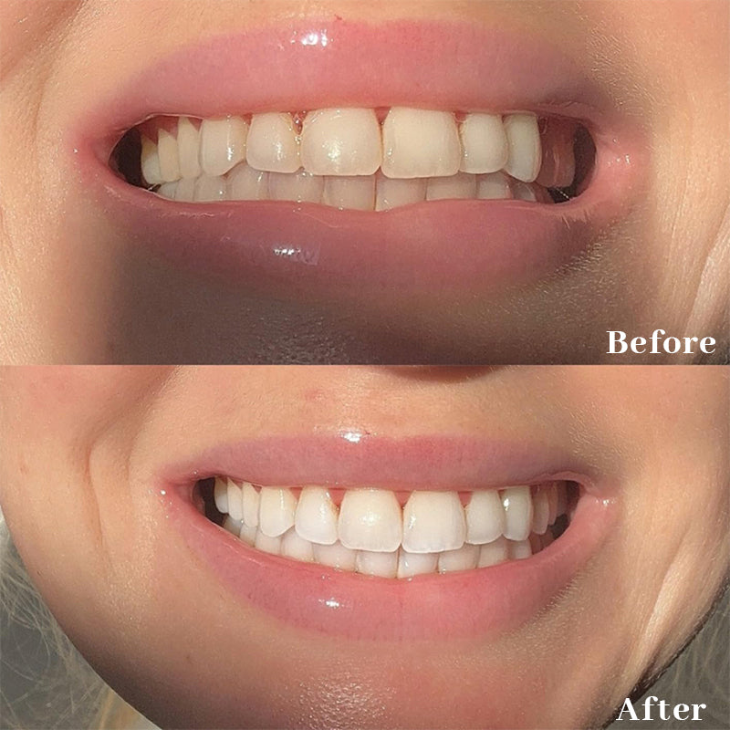 Smileasego™ Teeth Whitening Strips, Non-peroxide, Fluoride Free & Vegan,  28 Strips (14-day Treatment)