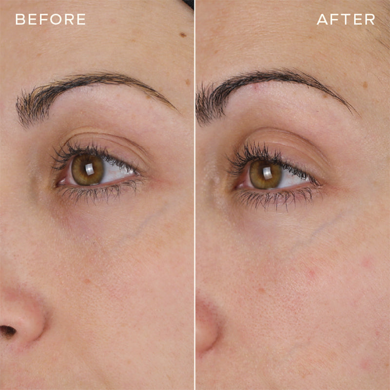 Newyuo™ Eye Serum with Caffeine & Retinol Hyaluronic Acid for Puffy Eye Bags, Fine Lines & Dark Circles